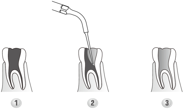 Сфера применения наконечника для скалера